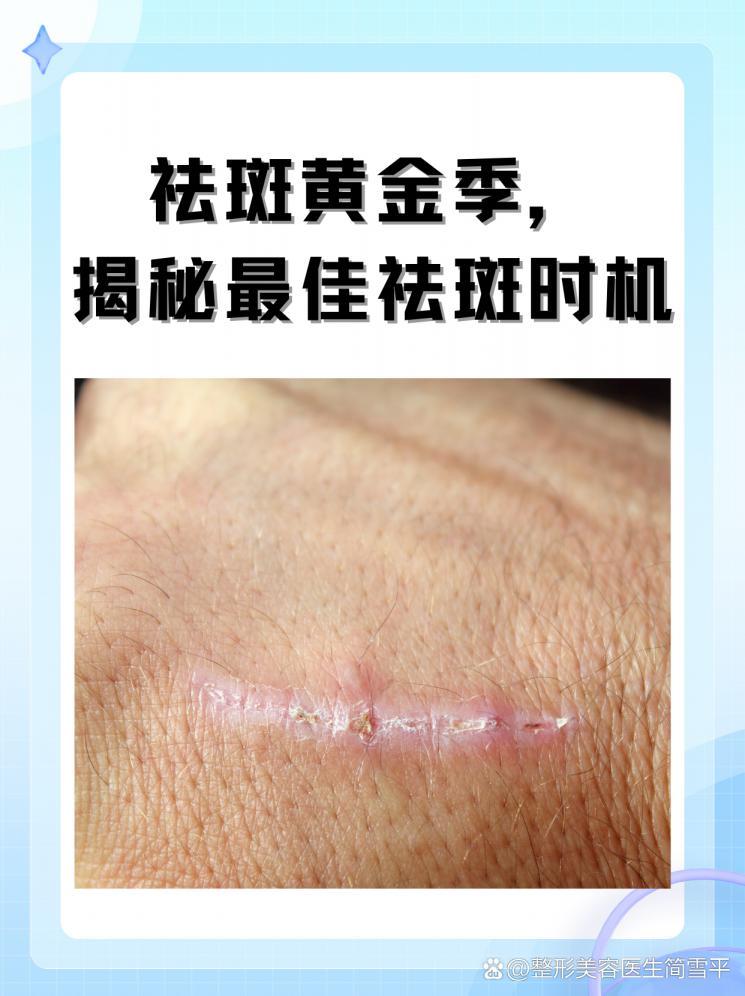 祛斑黄金季，揭秘最佳祛斑时机