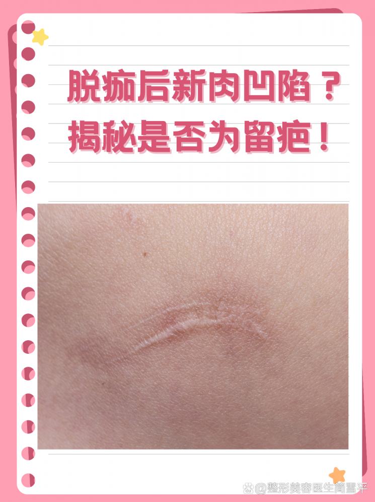 脱痂后新肉凹陷？揭秘是否为留疤！