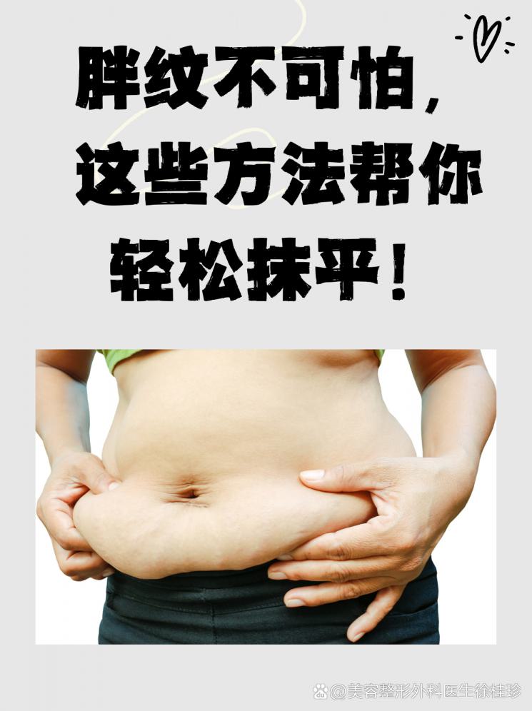 胖纹不可怕，这些方法帮你轻松抹平！