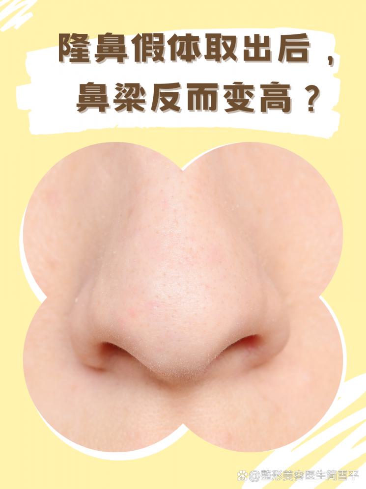 隆鼻假体取出后，鼻梁反而变高？