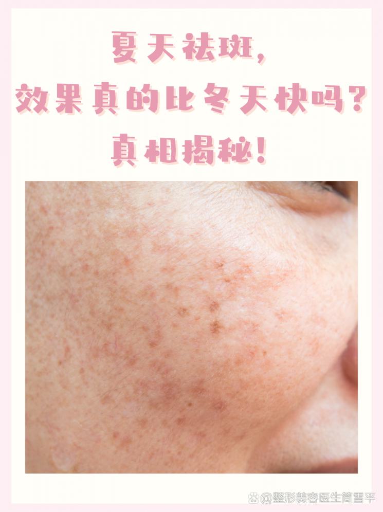 夏天祛斑，效果真的比冬天快吗？真相揭秘！