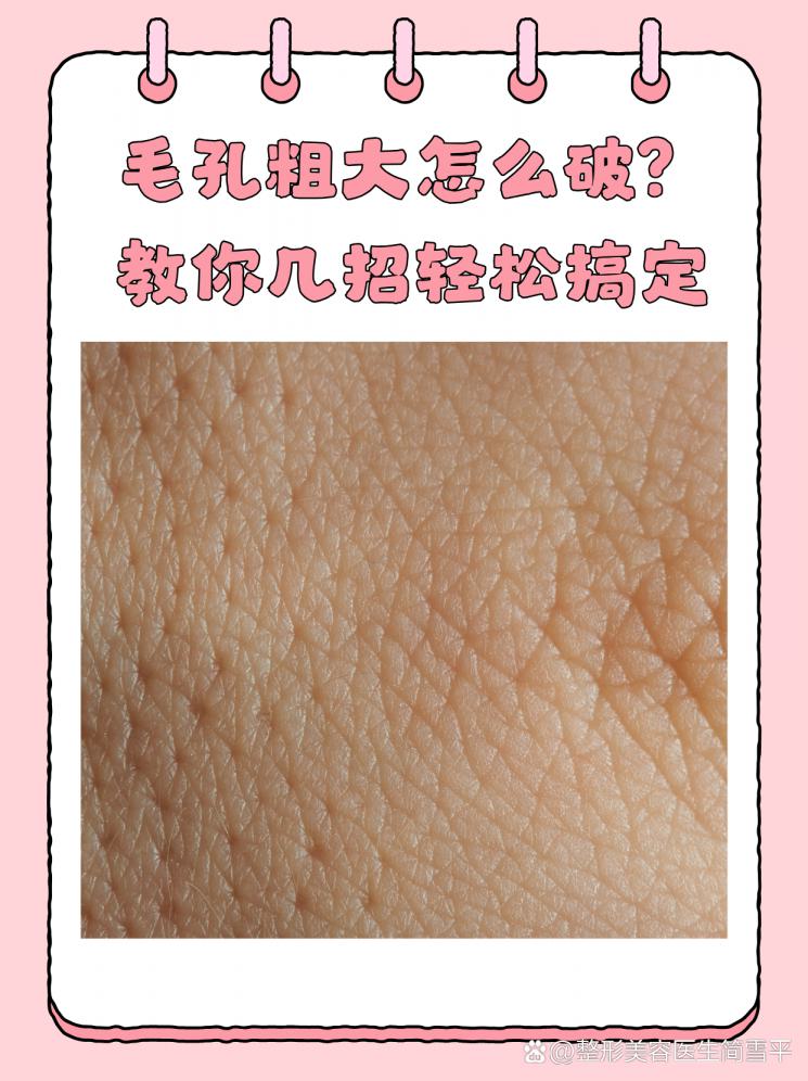 毛孔粗大怎么破？教你几招轻松搞定