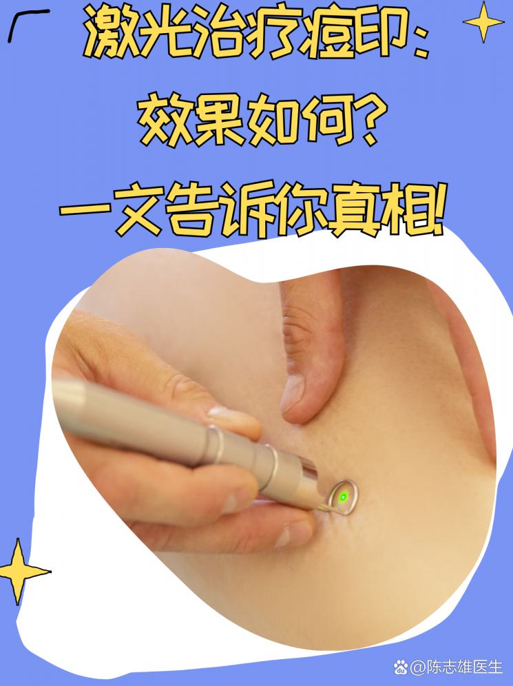 激光治疗痘印：效果如何？一文告诉你真相！