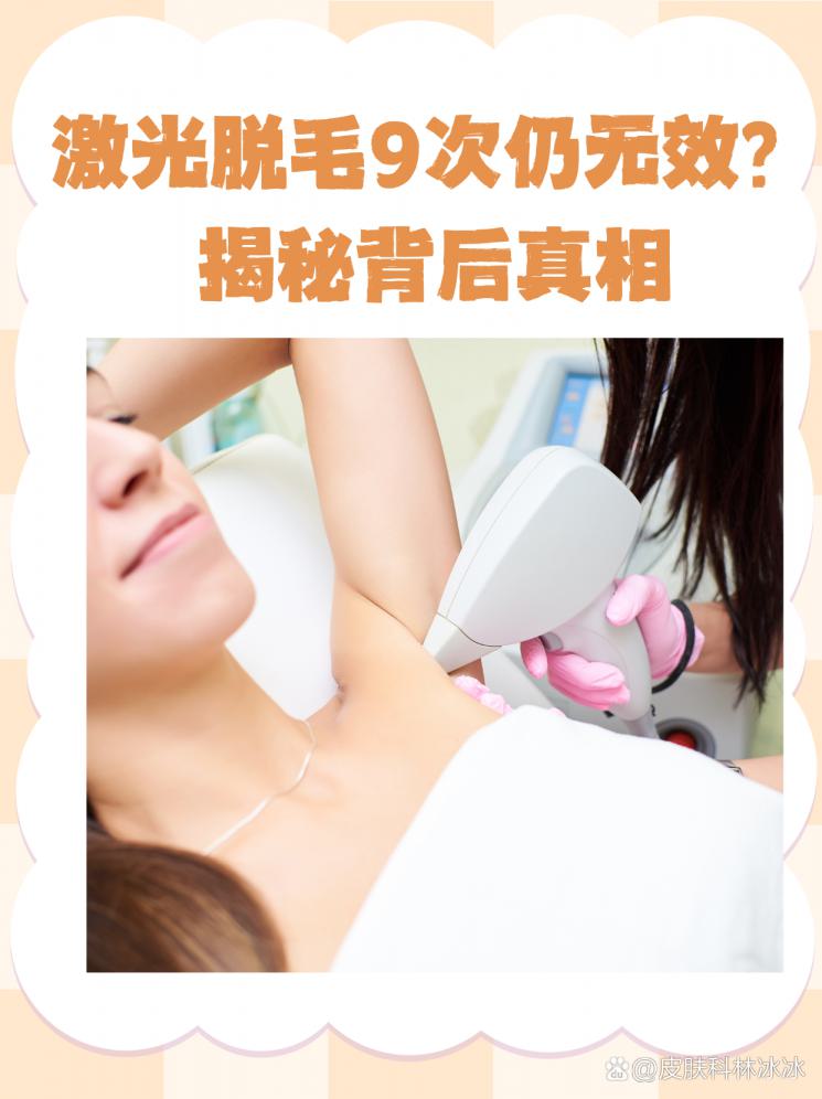 激光脱毛9次仍无效？揭秘背后真相
