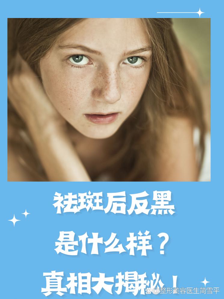 祛斑后反黑是什么样？真相大揭秘！