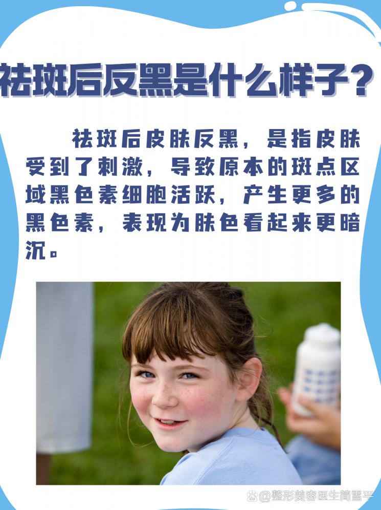 祛斑后反黑是什么样？真相大揭秘！