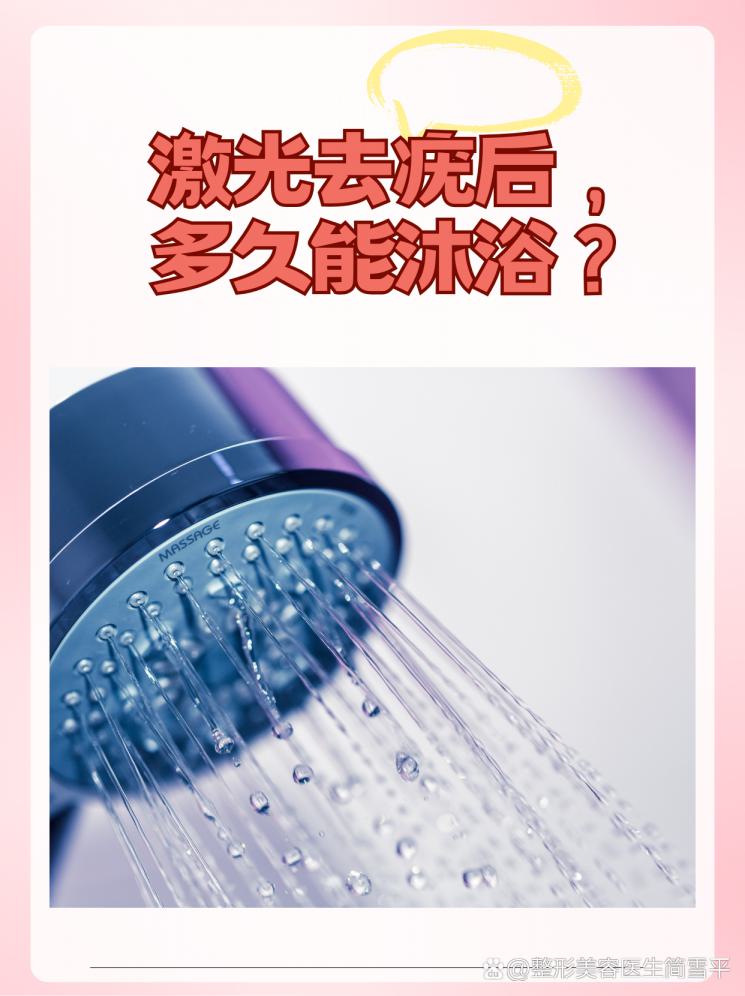 激光去疣后，多久能沐浴？