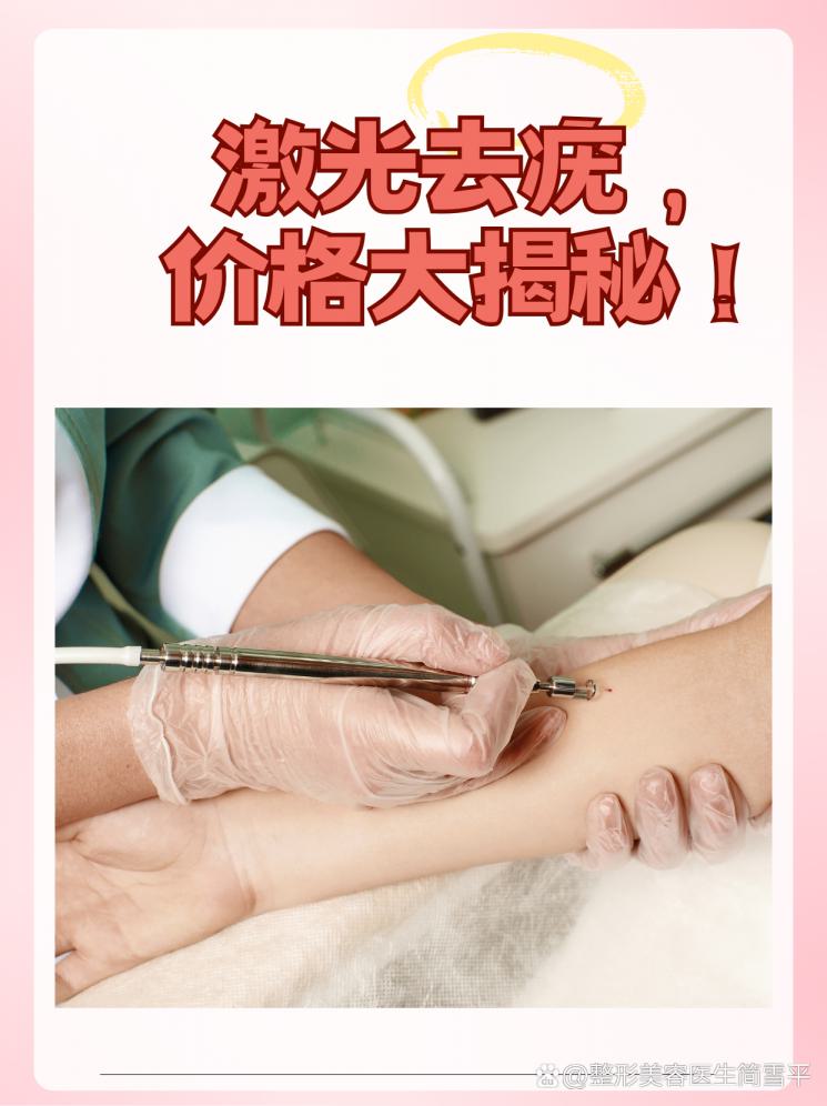 激光去疣，价格大揭秘！
