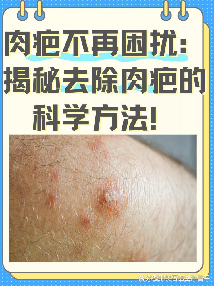 肉疤不再困扰：揭秘去除肉疤的科学方法！