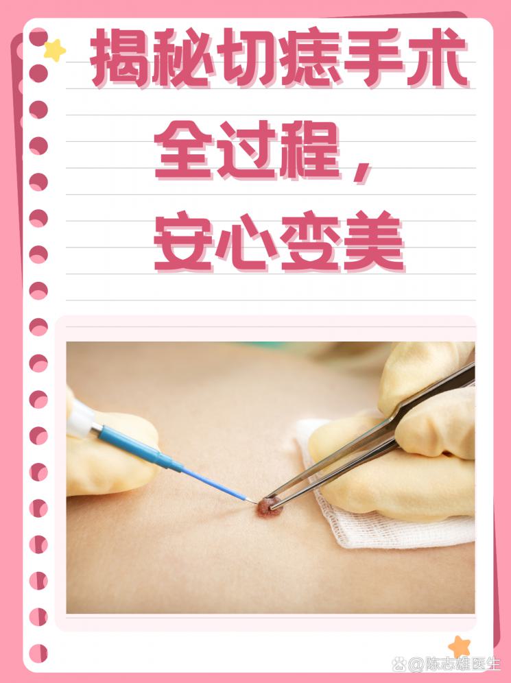 揭秘切痣手术全过程，安心变美