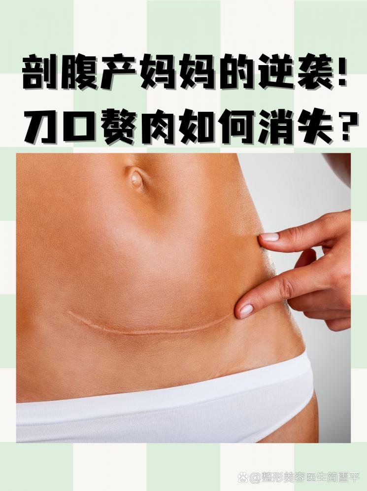 剖腹产妈妈的逆袭！刀口赘肉如何消失？