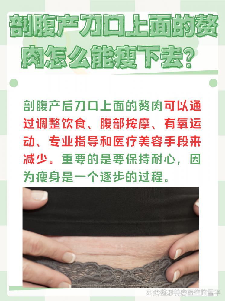 剖腹产妈妈的逆袭！刀口赘肉如何消失？