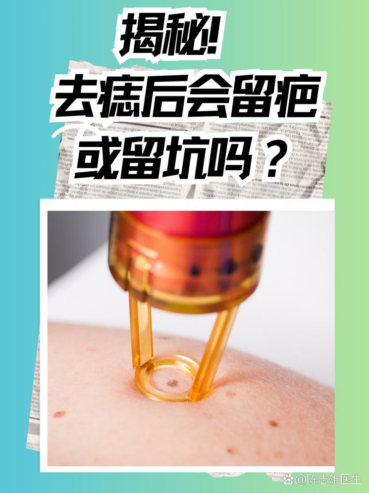 揭秘！去痣后后会留疤或留坑吗？