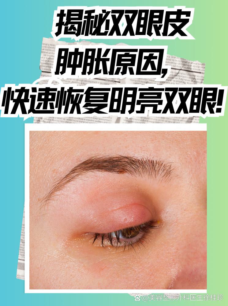 揭秘双眼皮肿胀原因，快速恢复明亮双眼！