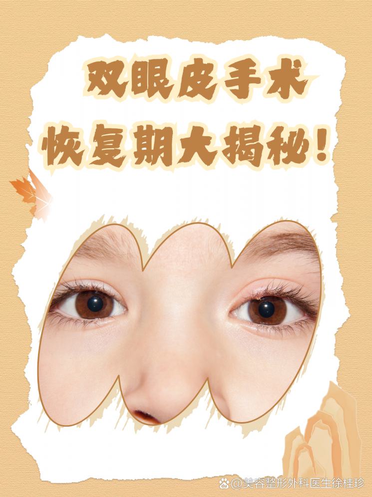 双眼皮手术恢复期大揭秘！
