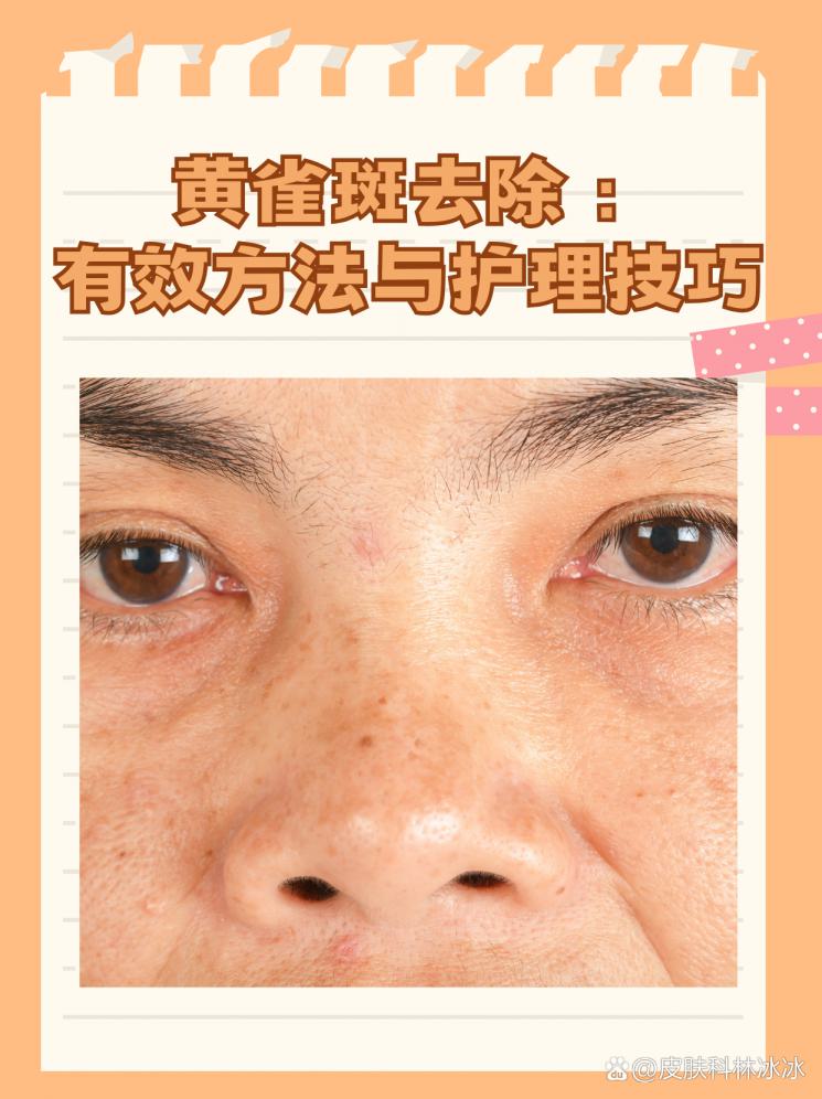 黄雀斑去除：有效方法与护理技巧