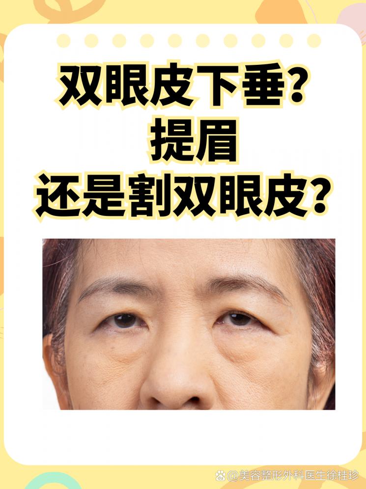 双眼皮下垂？提眉还是割双眼皮？