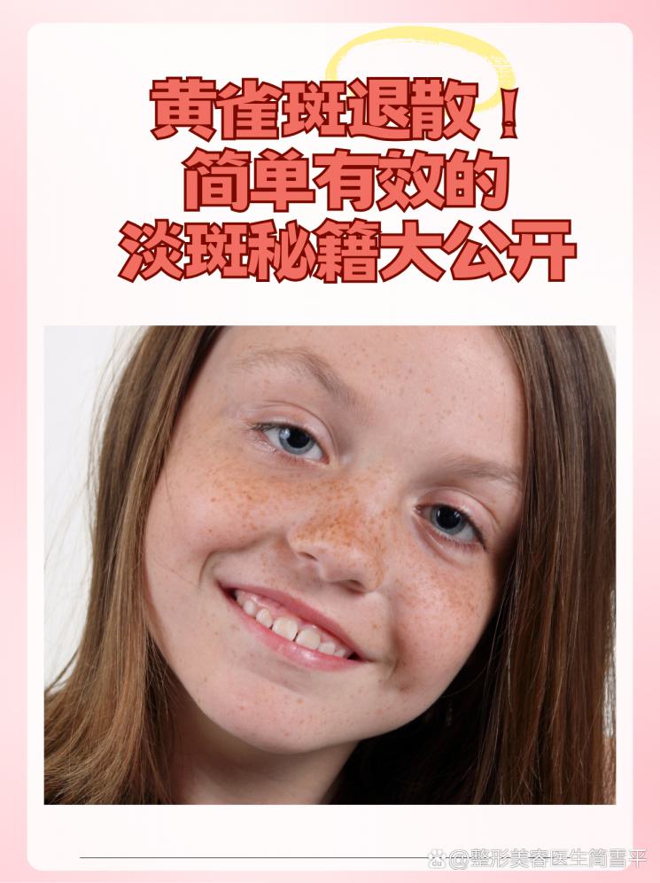 黄雀斑退散！简单有效的淡斑秘籍大公开