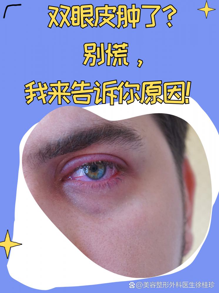 双眼皮肿了？别慌，我来告诉你原因！
