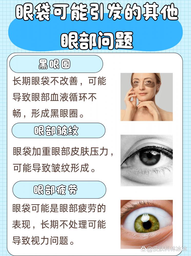 眼袋不再有！揭秘最佳去除眼袋秘籍