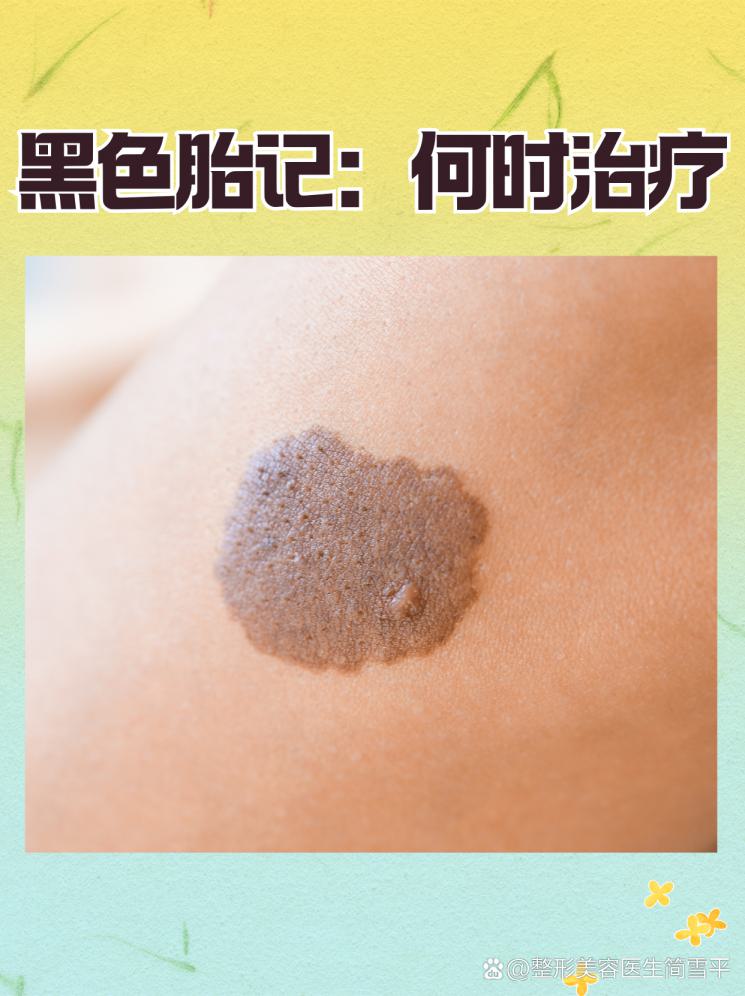 黑色胎记：何时治疗