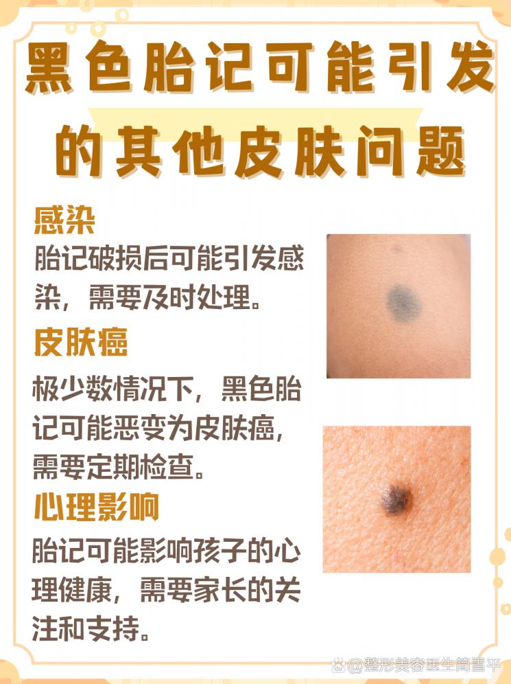 黑色胎记：何时治疗