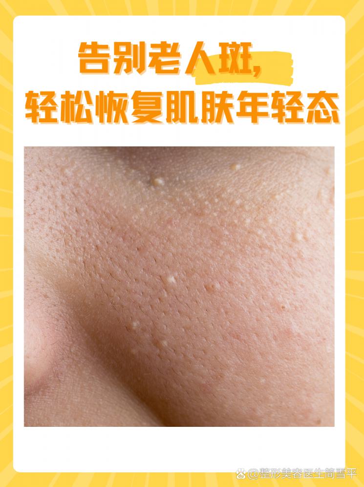告别老人斑，轻松恢复肌肤年轻态