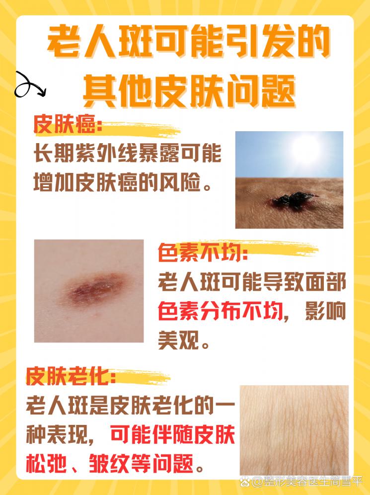 告别老人斑，轻松恢复肌肤年轻态