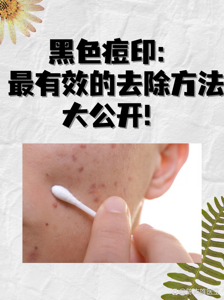黑色痘印：最有效的去除方法大公开！
