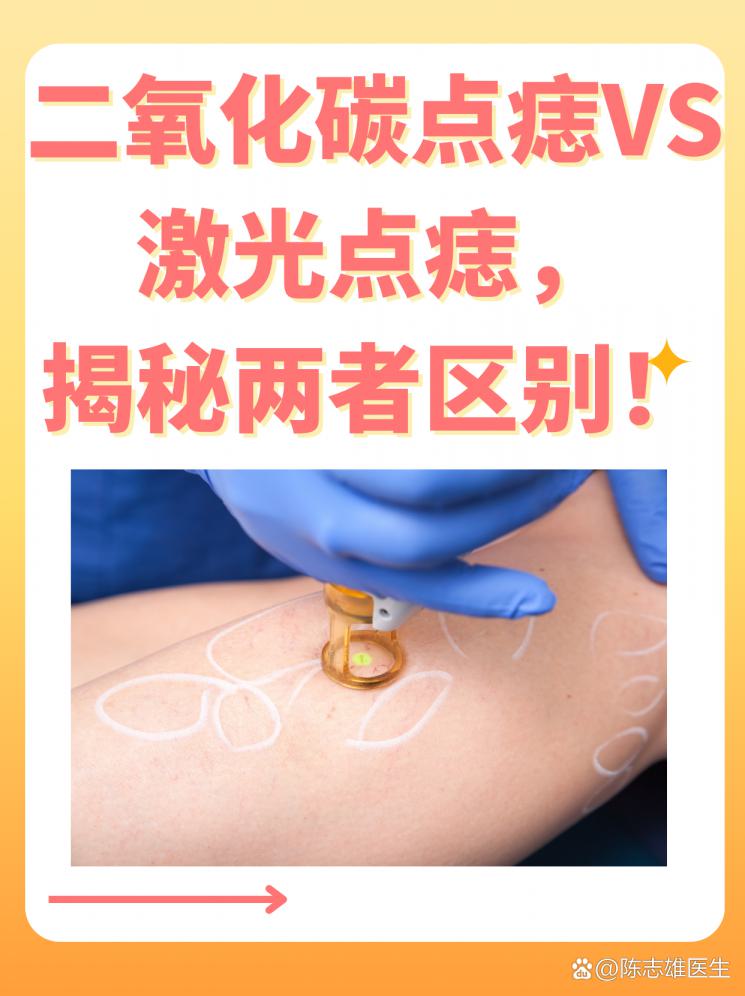 二氧化碳点痣VS激光点痣，揭秘两者区别！