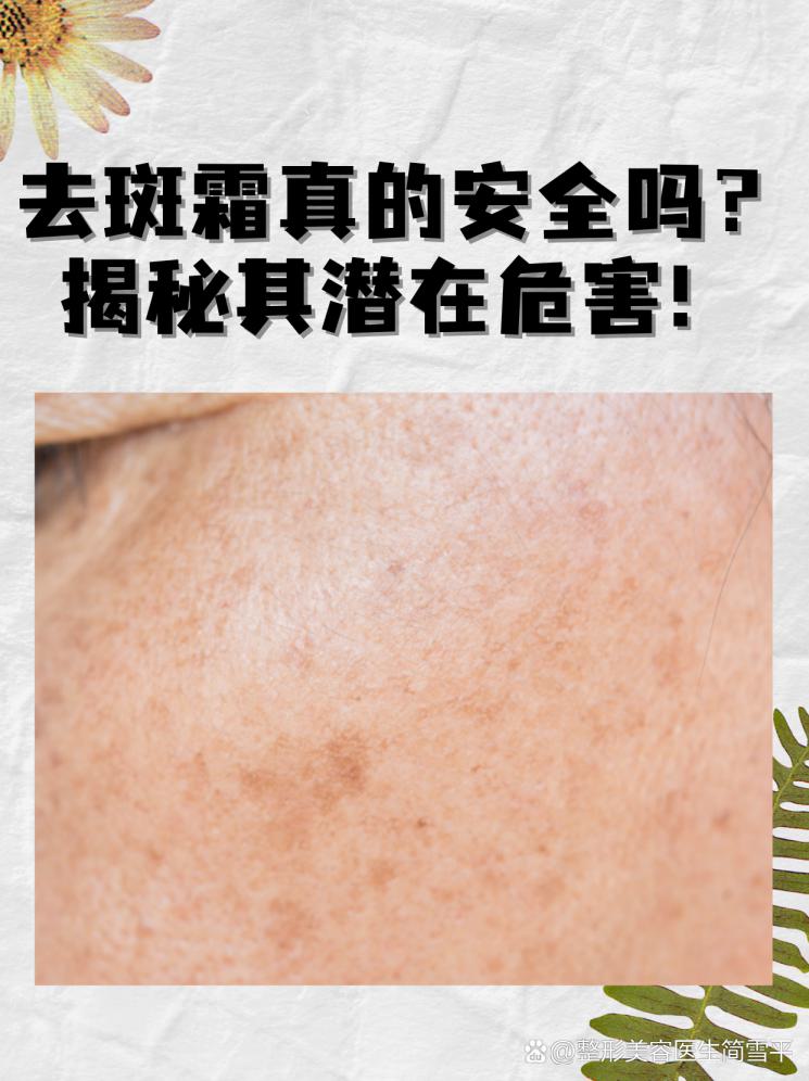 去斑霜真的安全吗？揭秘其潜在危害！