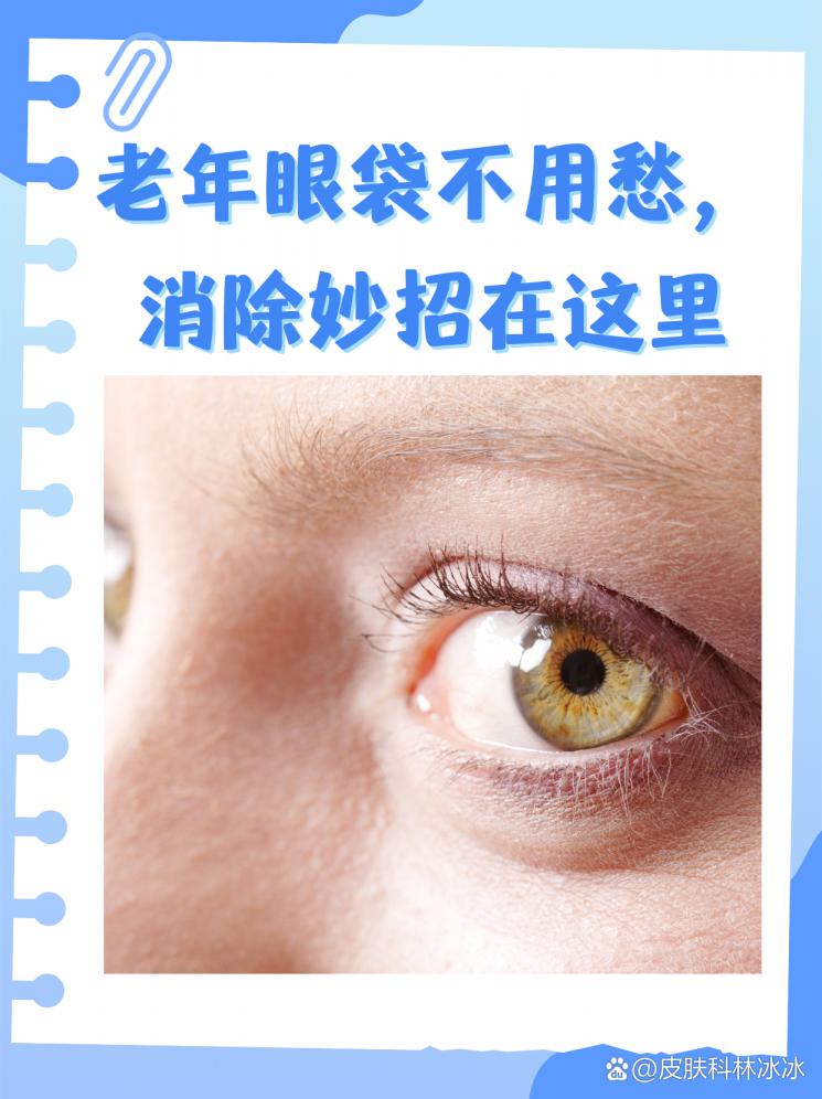 老年眼袋不用愁，消除妙招在这里