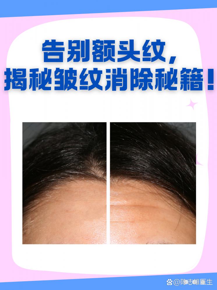 告别额头纹，揭秘皱纹消除秘籍！
