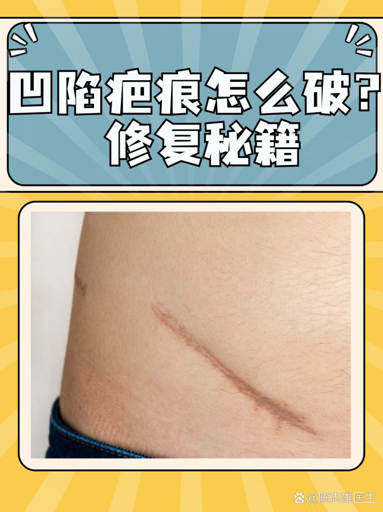 凹陷疤痕怎么破？修复秘籍