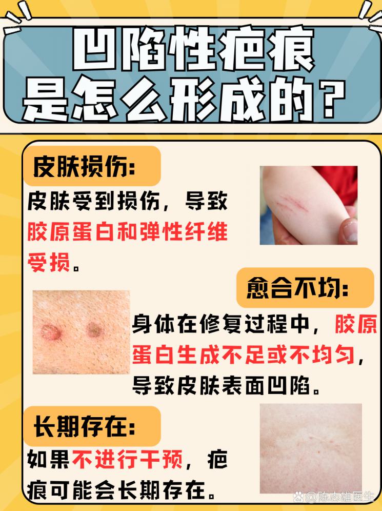凹陷疤痕怎么破？修复秘籍