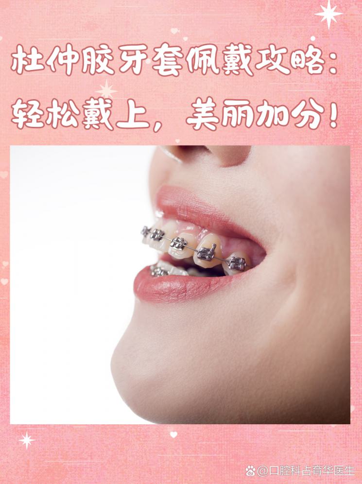 杜仲胶牙套佩戴攻略：轻松戴上，美丽加分！