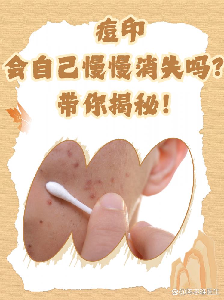 痘印会自己慢慢消失吗？带你揭秘！