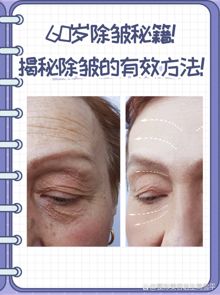 60岁除皱秘籍！揭秘除皱的有效方法！