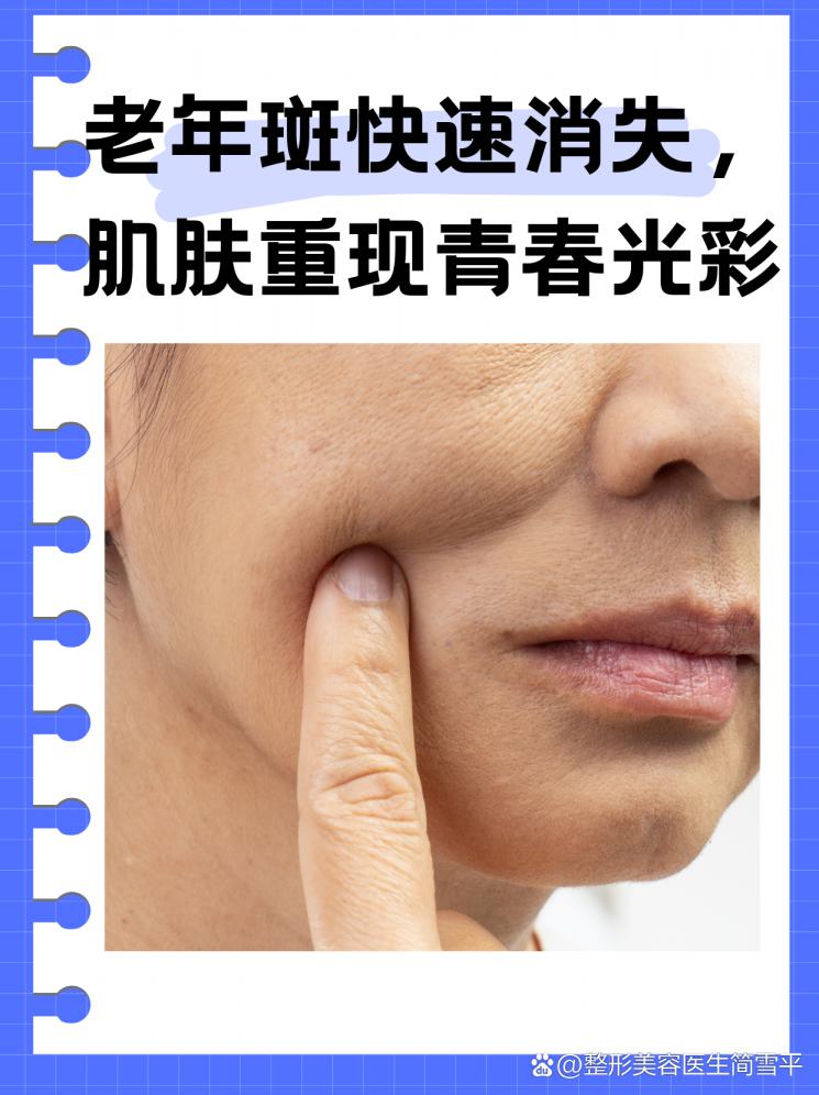 老年斑快速消失，肌肤重现青春光彩