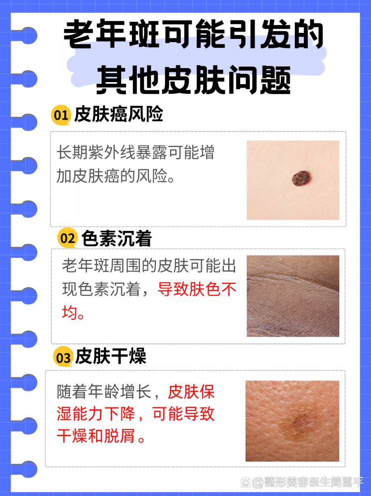 老年斑快速消失，肌肤重现青春光彩