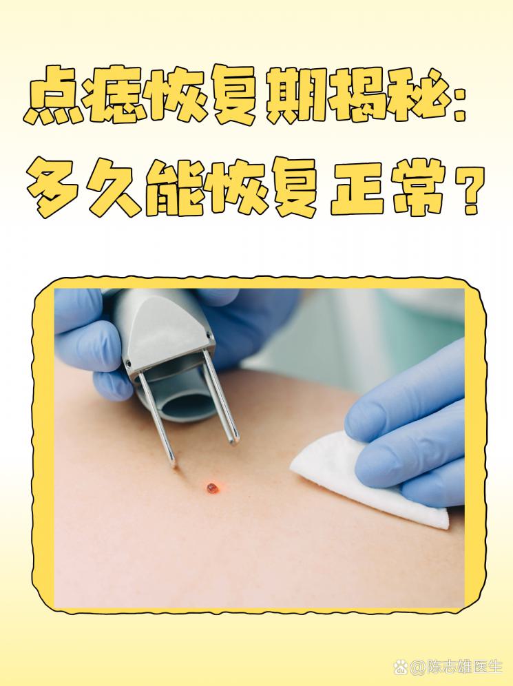 点痣恢复期揭秘：多久能恢复正常？