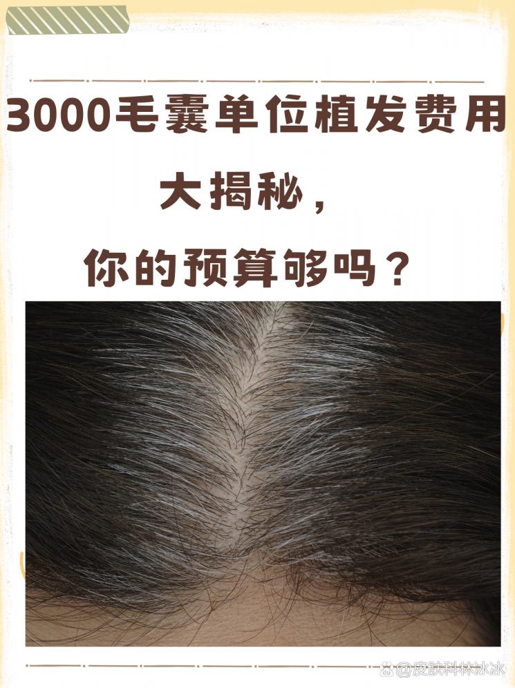 3000毛囊单位植发费用大揭秘，你的预算够吗？