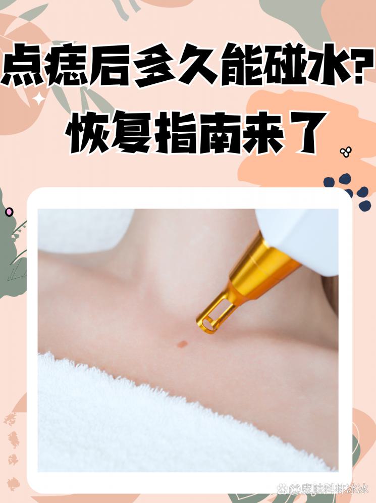 点痣后多久能碰水？恢复指南来了