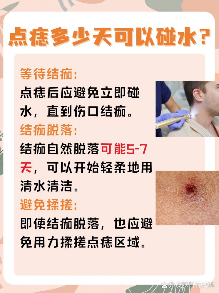 点痣后多久能碰水？恢复指南来了