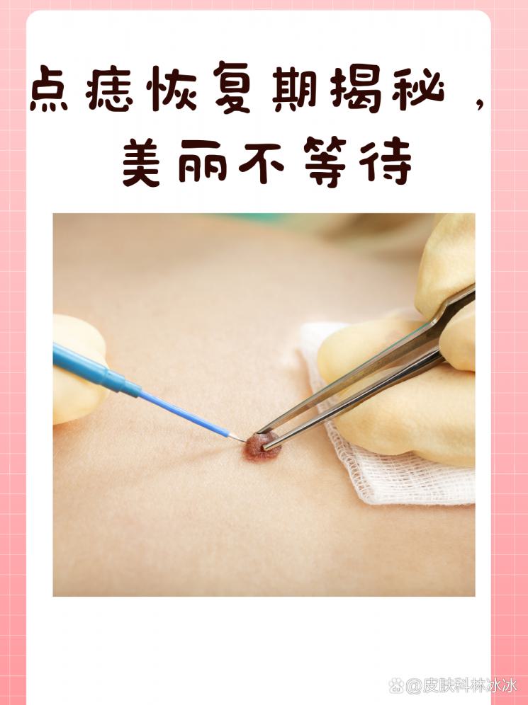 点痣恢复期揭秘，美丽不等待