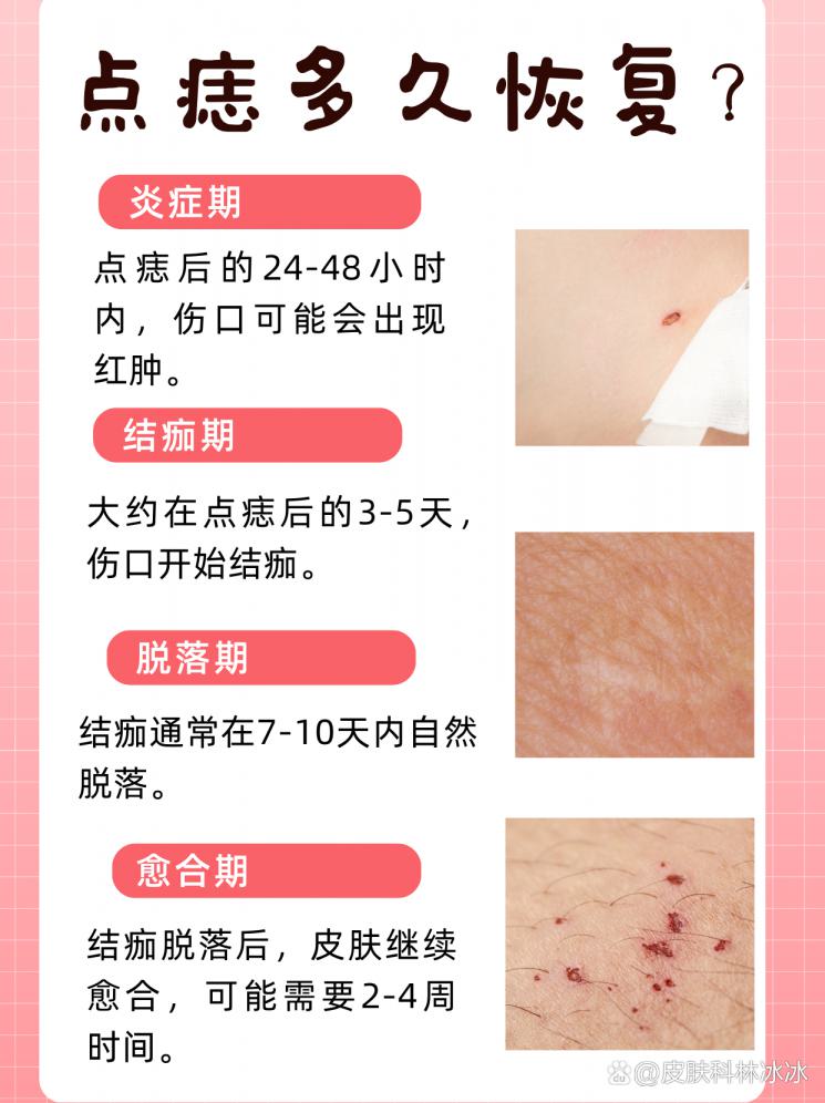 点痣恢复期揭秘，美丽不等待