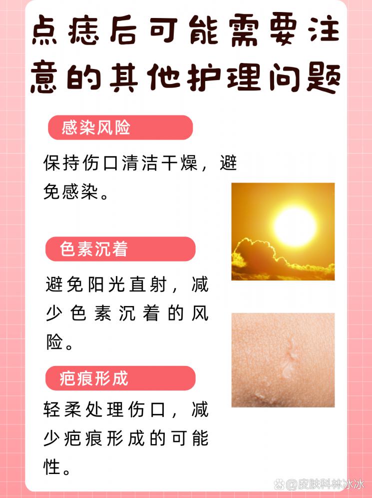 点痣恢复期揭秘，美丽不等待