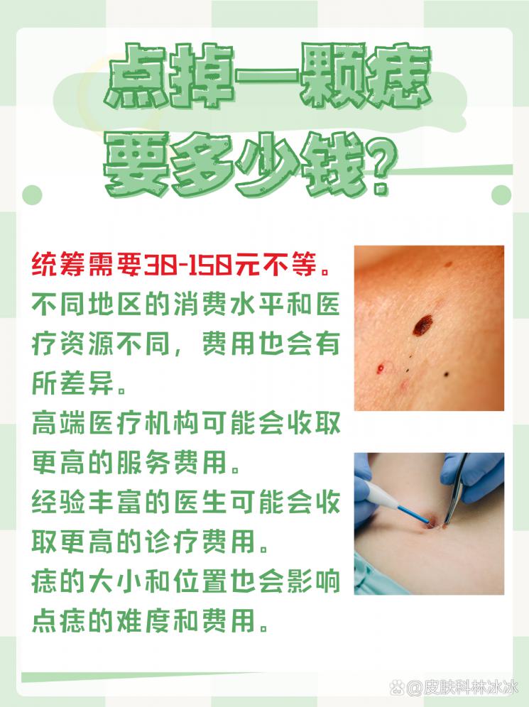 点痣费用大揭秘，美丽不设限