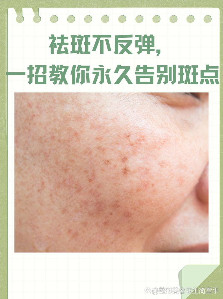 祛斑不反弹，一招教你永久告别斑点