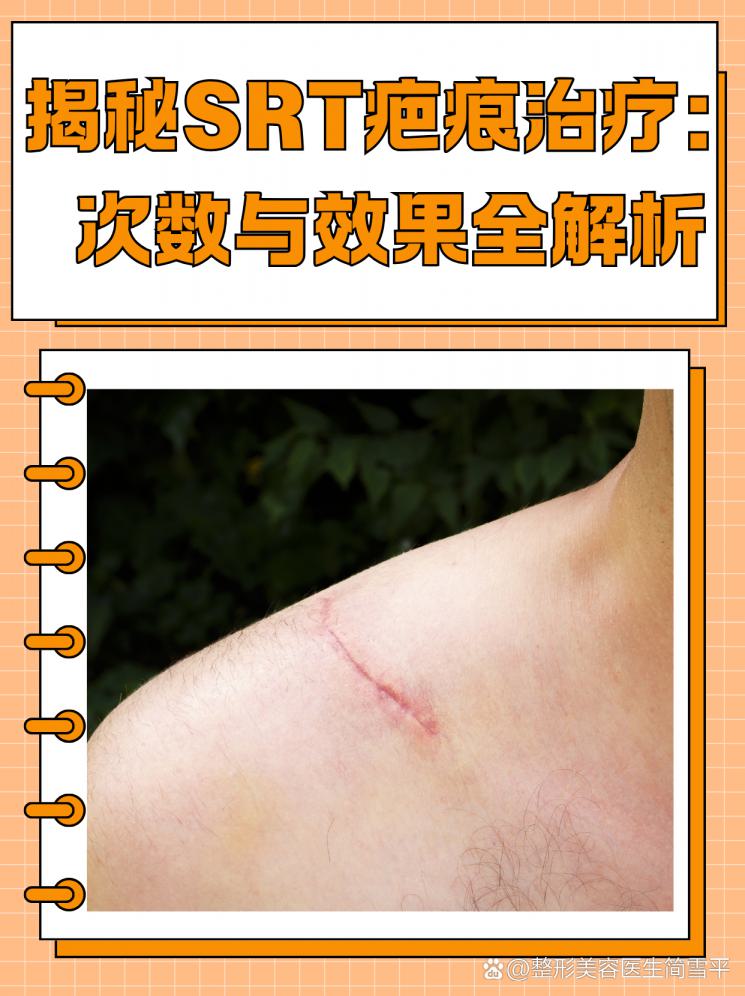 揭秘SRT疤痕治疗：次数与效果全解析